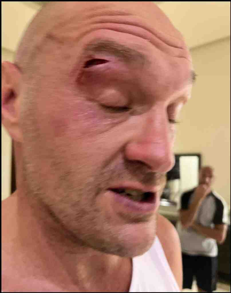 Fury vs Usyk postponed: Tyson cut in sparring, fight off
